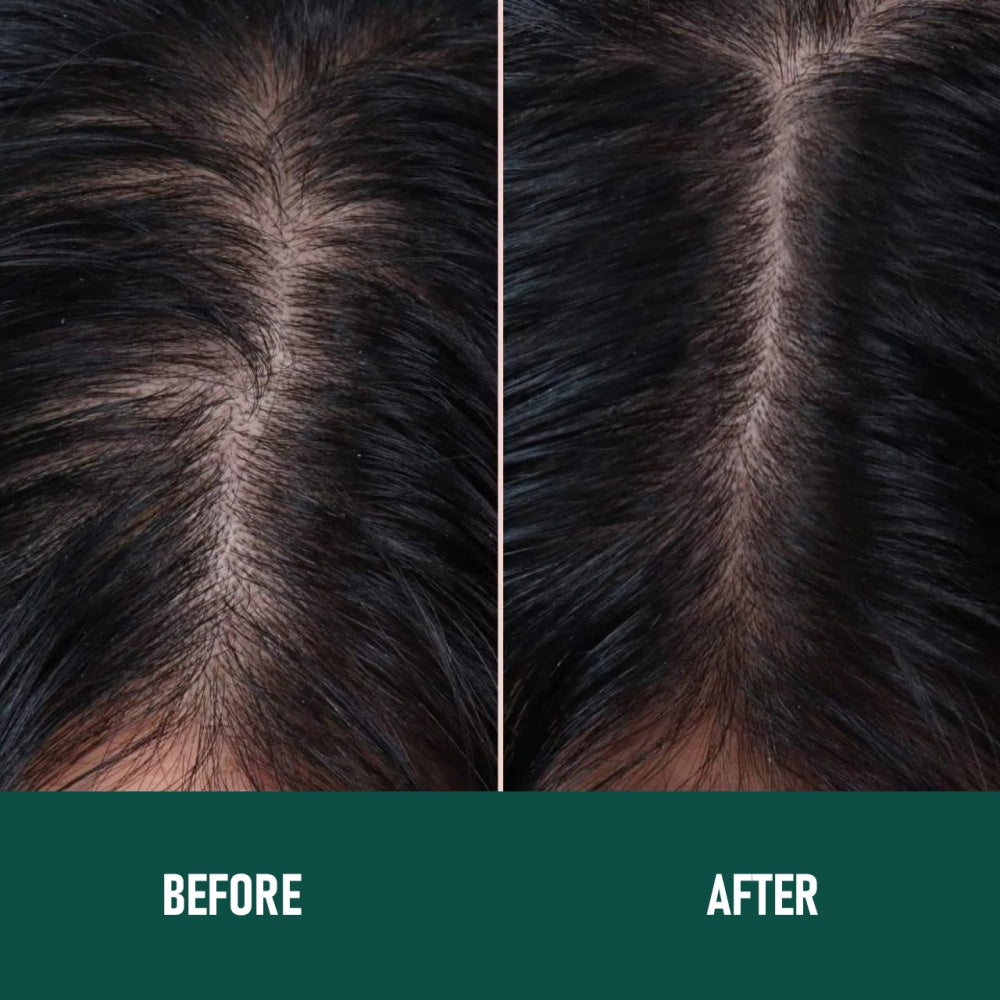 Velorian Collection CH004 Minoxidil Anti-Hair Loss Mousse in a pump bottle for hair regrowth treatment.