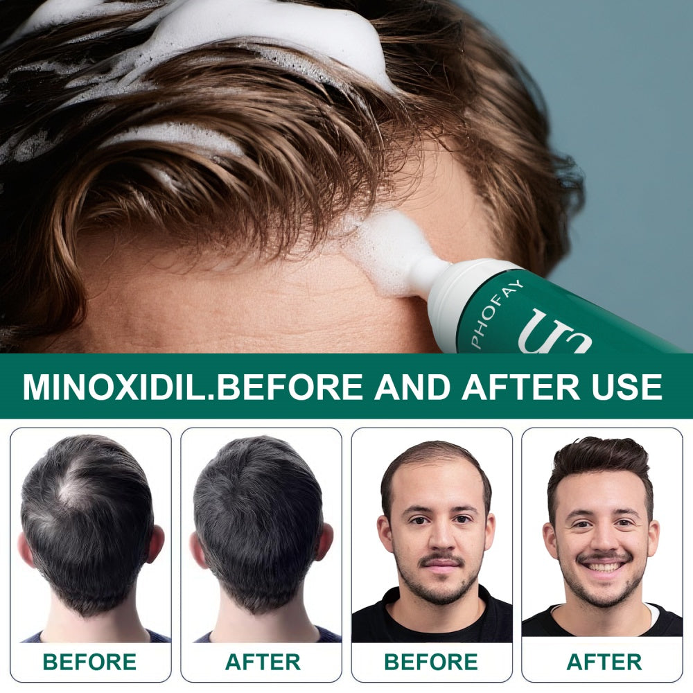 Velorian Collection CH004 Minoxidil Anti-Hair Loss Mousse in a bottle with a pump for hair thinning treatment.
